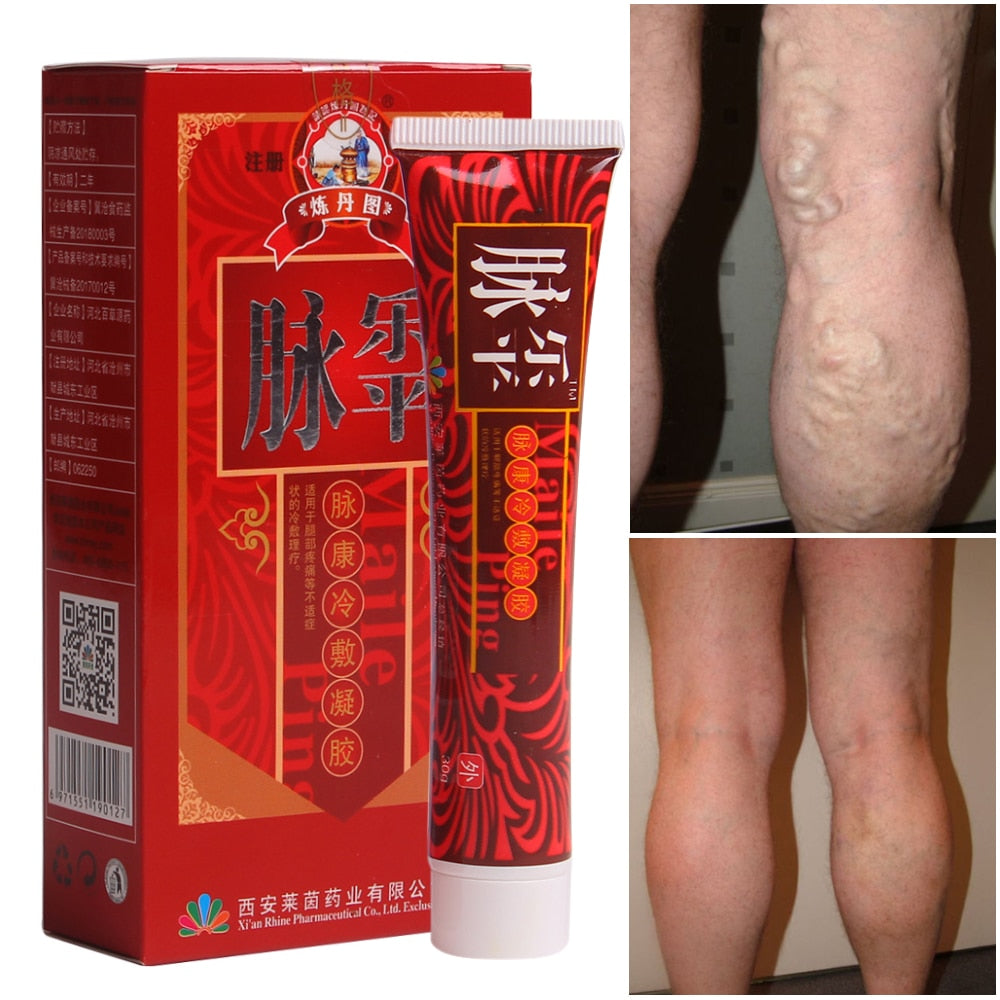 Varicose Veins Treatment Cream Ointment Vasculitis Phlebitis Spider Veins Pain­ Varicosity Angiitis Remedy Removal Herbal Cream - fadelictionshop